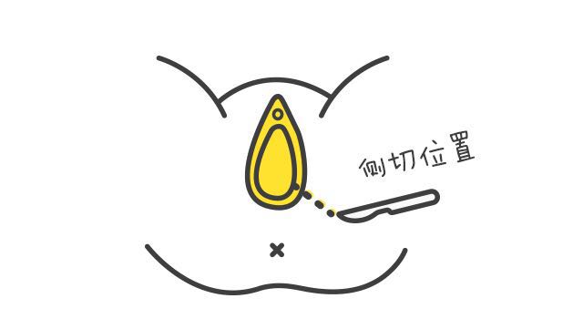 分娩应该选择剖腹产还是顺产呢,顺产和剖腹产必选的几个选项