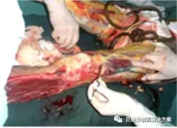 烧伤的治疗,烧伤的治疗土方