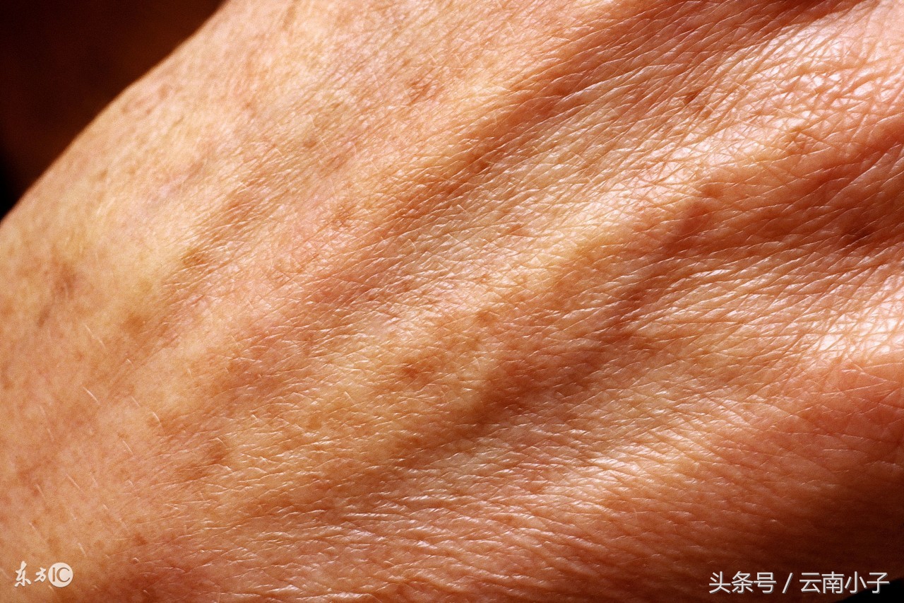 我吃三七粉,主要降低三高,怎么脸上的雀斑全没了!