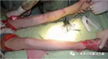 烧伤的治疗,烧伤的治疗土方