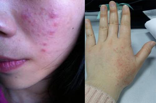 用什么方法治湿疹不再犯,治湿疹天然方法