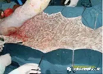 烧伤的治疗,烧伤的治疗土方