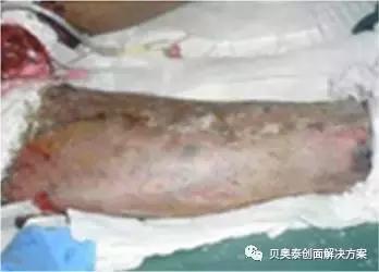 烧伤的治疗,烧伤的治疗土方