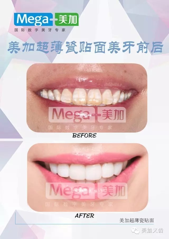 美牙仪和洗牙哪个好,冷光美白和牙齿贴片哪个好点