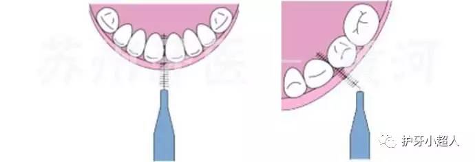 50岁牙缝变大怎么修复,牙缝变大吃什么药能修复