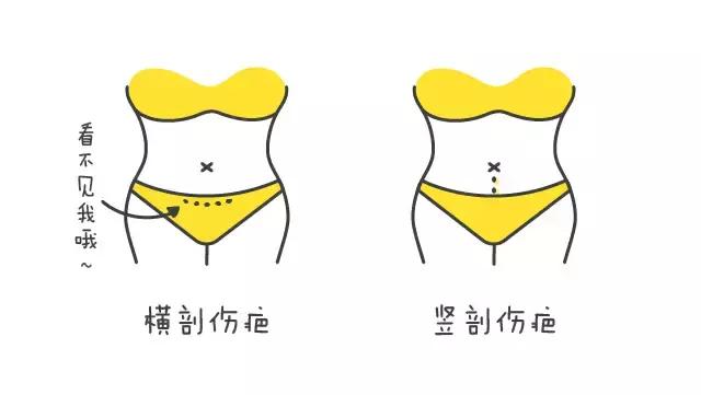 分娩应该选择剖腹产还是顺产呢,顺产和剖腹产必选的几个选项