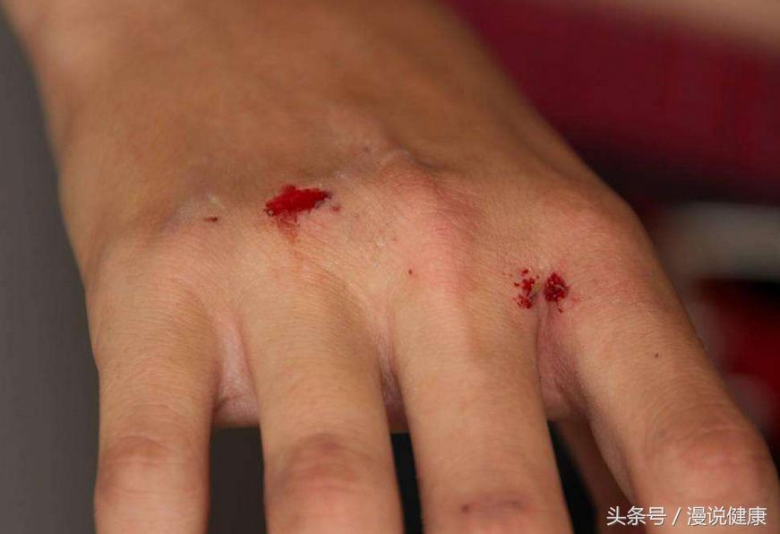 手指被鱼刺扎了要多久能好,指甲扎进鱼刺用打破伤风吗