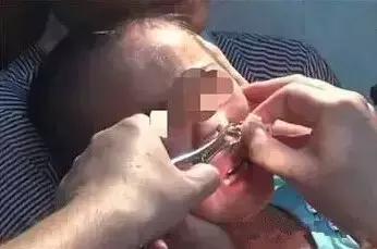 孩子鼻子有异物要做手术取出,3岁宝宝鼻子痒怎么处理