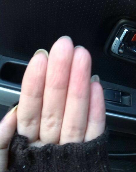 看双手就知道贫血与否!贫血只需补一种营养