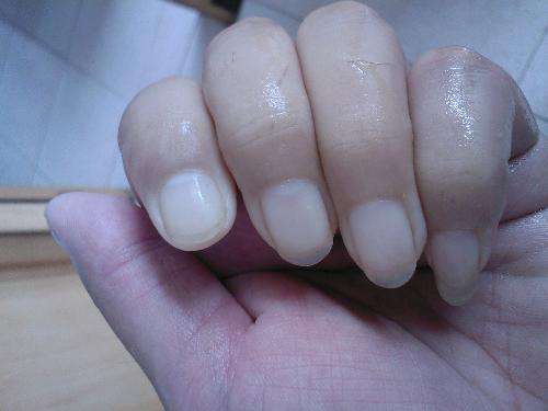 看双手就知道贫血与否!贫血只需补一种营养