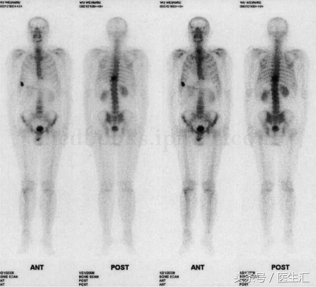 癌症脊柱骨转移怎么治疗,脊柱转移恶性肿瘤的最佳治疗方法