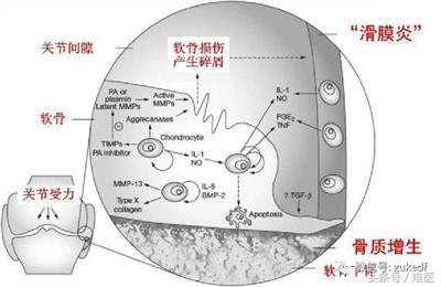 关节炎滑膜炎骨质增生能治好吗,髌骨关节炎骨质增生就是滑膜炎吗