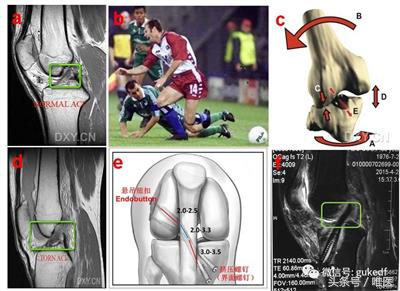 关节炎滑膜炎骨质增生能治好吗,髌骨关节炎骨质增生就是滑膜炎吗