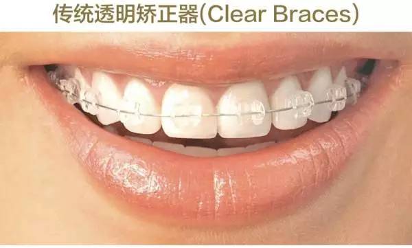 牙整形需要什么过程,整形整牙全过程