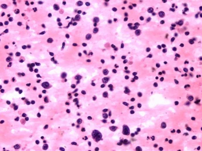 过敏性紫癜是用中医还是西医,过敏性紫癜西医治好还是中医治好