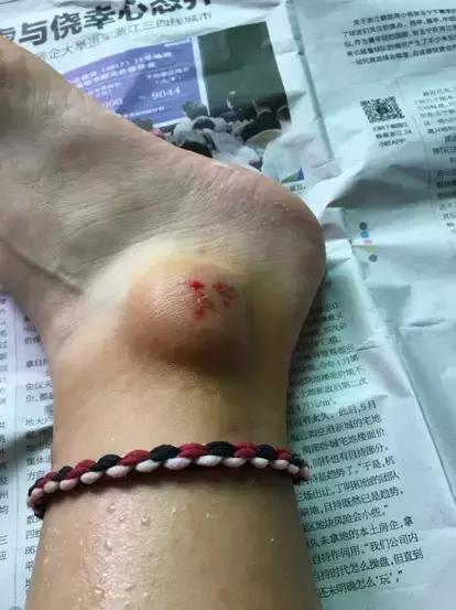 骑自行车同伴被狗咬,骑自行车被狗咬了怎么办