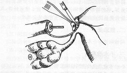 输卵管结扎复通术病历书写,输卵管结扎术后能不能做试管