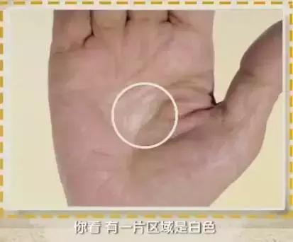 手上发紫中间发白,手上发紫发青还发痒是怎么回事