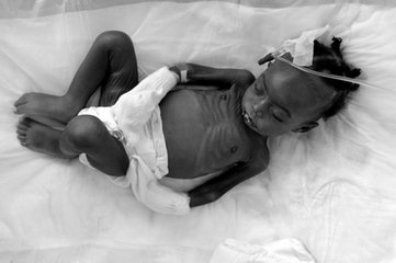 一岁半宝宝营养不良如何食补,营养不良的宝宝