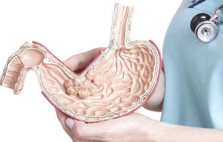 全国有最多的胃癌患者,全国胃癌最好的专家是谁