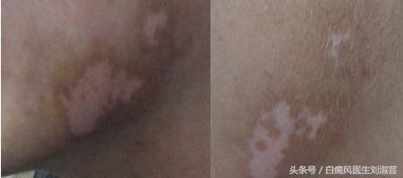 白癜风擦药后变红刺痛有水泡,白癜风用药起水泡怎么办