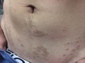 湿疹的根源在哪里怎样才能根治,湿疹怎么治疗不留后遗症