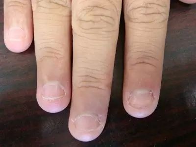 甲沟炎太疼了在家怎么处理,怎么样剪指甲可以预防甲沟炎