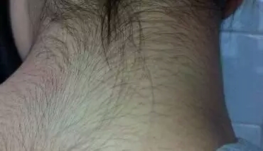 身体突然长毛是什么激素,长毛发的是什么激素