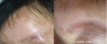 白癜风擦药后变红刺痛有水泡,白癜风用药起水泡怎么办