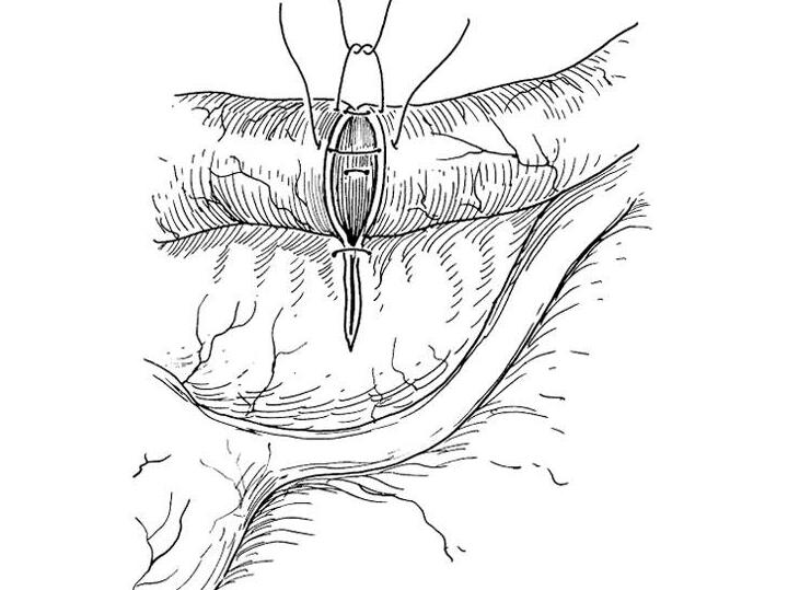 输卵管结扎复通术病历书写,输卵管结扎术后能不能做试管
