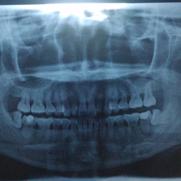 人为什么会长智齿智齿有什么作用,什么是智齿为什么叫智齿