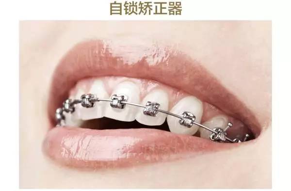 牙整形需要什么过程,整形整牙全过程