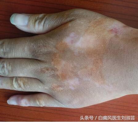 白癜风擦药后变红刺痛有水泡,白癜风用药起水泡怎么办