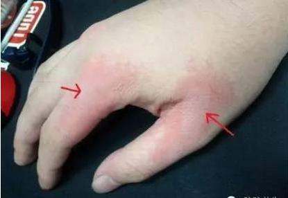 鸡蛋这样吃,既能治湿疹皮炎手足癣,还对胃疼胃溃疡特有效