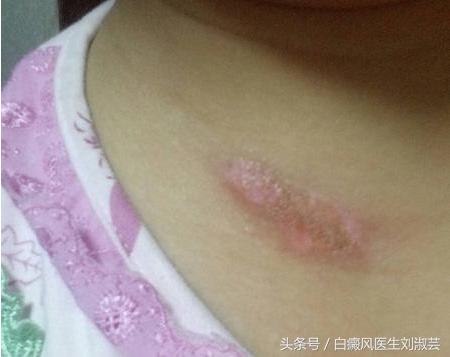 白癜风擦药后变红刺痛有水泡,白癜风用药起水泡怎么办