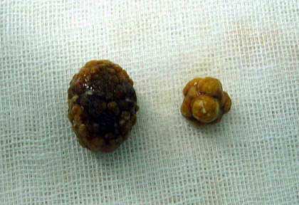 腰子含嘌呤多还是豆皮多,结石可以吃腰子吗