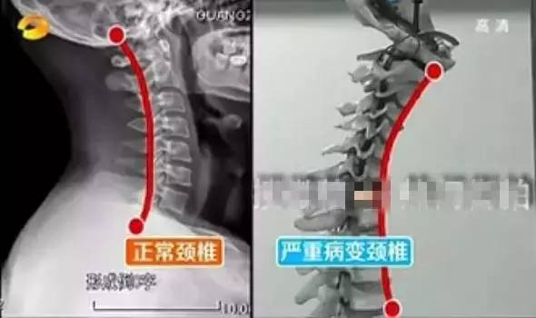 低头族别再谋杀颈椎了,学生经常低头颈椎危害案例