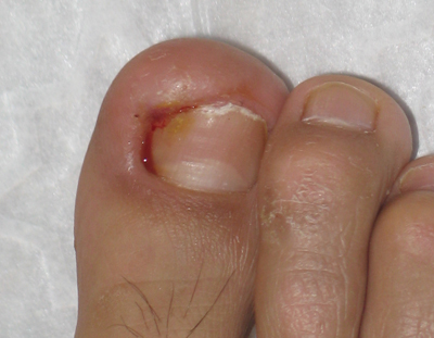 甲沟炎太疼了在家怎么处理,怎么样剪指甲可以预防甲沟炎