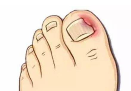 甲沟炎太疼了在家怎么处理,怎么样剪指甲可以预防甲沟炎