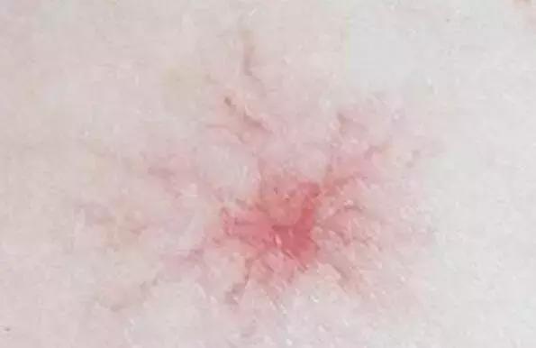 身上出现小红痣是什么病症状,身上开始出现小红痣图片