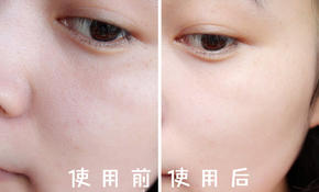 薏仁水娥佩兰收缩毛孔吗,收缩毛孔城野医生有用吗