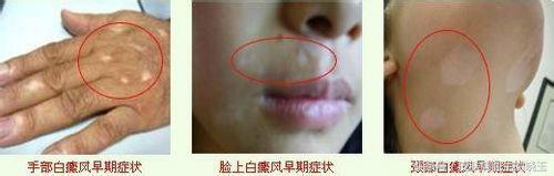 白癜风发病早期有什么手段能控制,对白癜风最有效的治疗