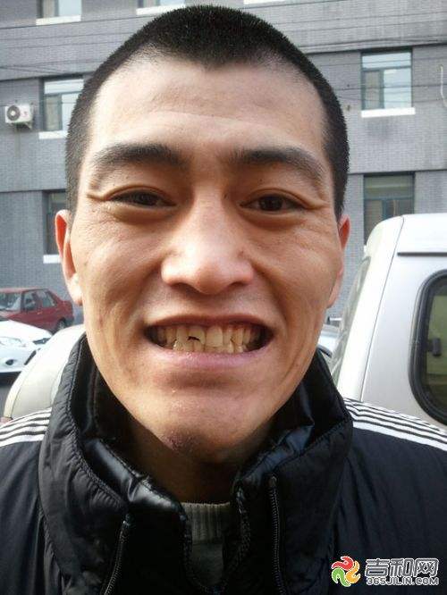 牙齿畸形不矫正的危害,牙齿畸形严重能矫正吗