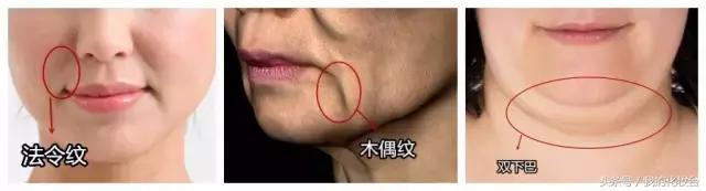 去天生颈纹的方法,颈纹多怎么锻炼