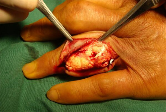 痛风未发作时降尿酸吃什么药,痛风吃什么药快速消肿止痛降尿酸