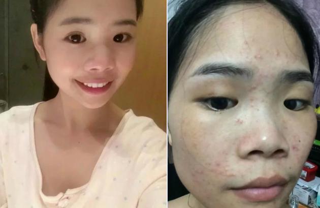 粉刺针弄完痘痘变得很大,粉刺针用了长痘