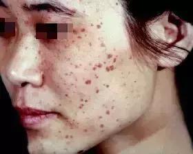 扁平疣打干扰素的危害,男性扁平疣有什么危害