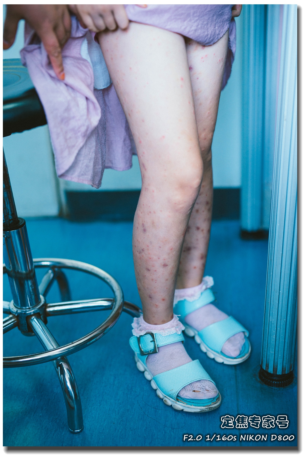 孩子肚子疼关节痛，等皮肤出了斑点才发现原来被它给骗了