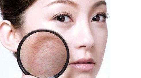 怎样才能有效解决毛孔粗大问题,简单轻松解决毛孔粗大的问题