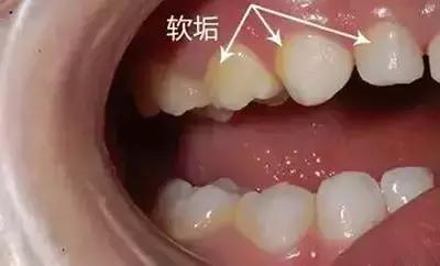 小朋友牙齿上的黑斑怎么办,小朋友牙齿有色素怎么办